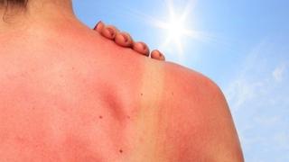 Utjecaj lijekova na kožu prilikom izlaganja suncu: Čak i aspirin može uzrokovati opekline
